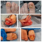 Zabieg usunięcia osteofitu z plastyką opuszka