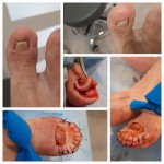 Zabieg usunięcia osteofitu z plastyką opuszka