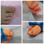 Zabieg usunięcia osteofitu z plastyką opuszka