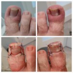 Wrastający paznokieć, stan po zabiegu plastyki wału paznokcia