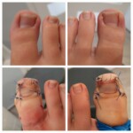 Stan zaraz po zabiegu