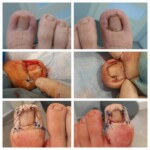 Obraz wyciętej częściowo płytki po klasycznym zabiegu klinowej resekcji paznokcia- zdjęcia w trakcie zabiegu plastyki wału Wrastający paznokieć