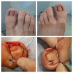 Obraz wyciętej częściowo płytki po klasycznym zabiegu klinowej resekcji paznokcia- zdjęcia w trakcie zabiegu plastyki wału Wrastający paznokieć