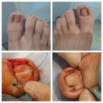 Obraz wyciętej częściowo płytki po klasycznym zabiegu klinowej resekcji paznokcia- zdjęcia w trakcie zabiegu plastyki wału Wrastający paznokieć